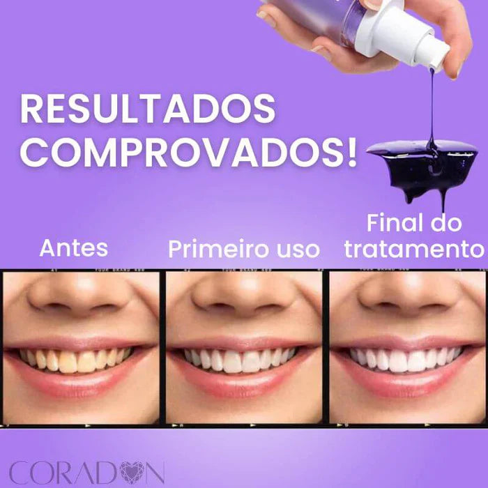 Clareador Dental Smile - Dentes Brancos Em Segundos